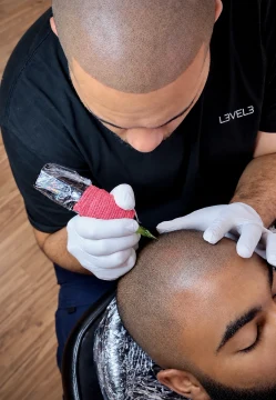 Scalp micropigmentation in progress.