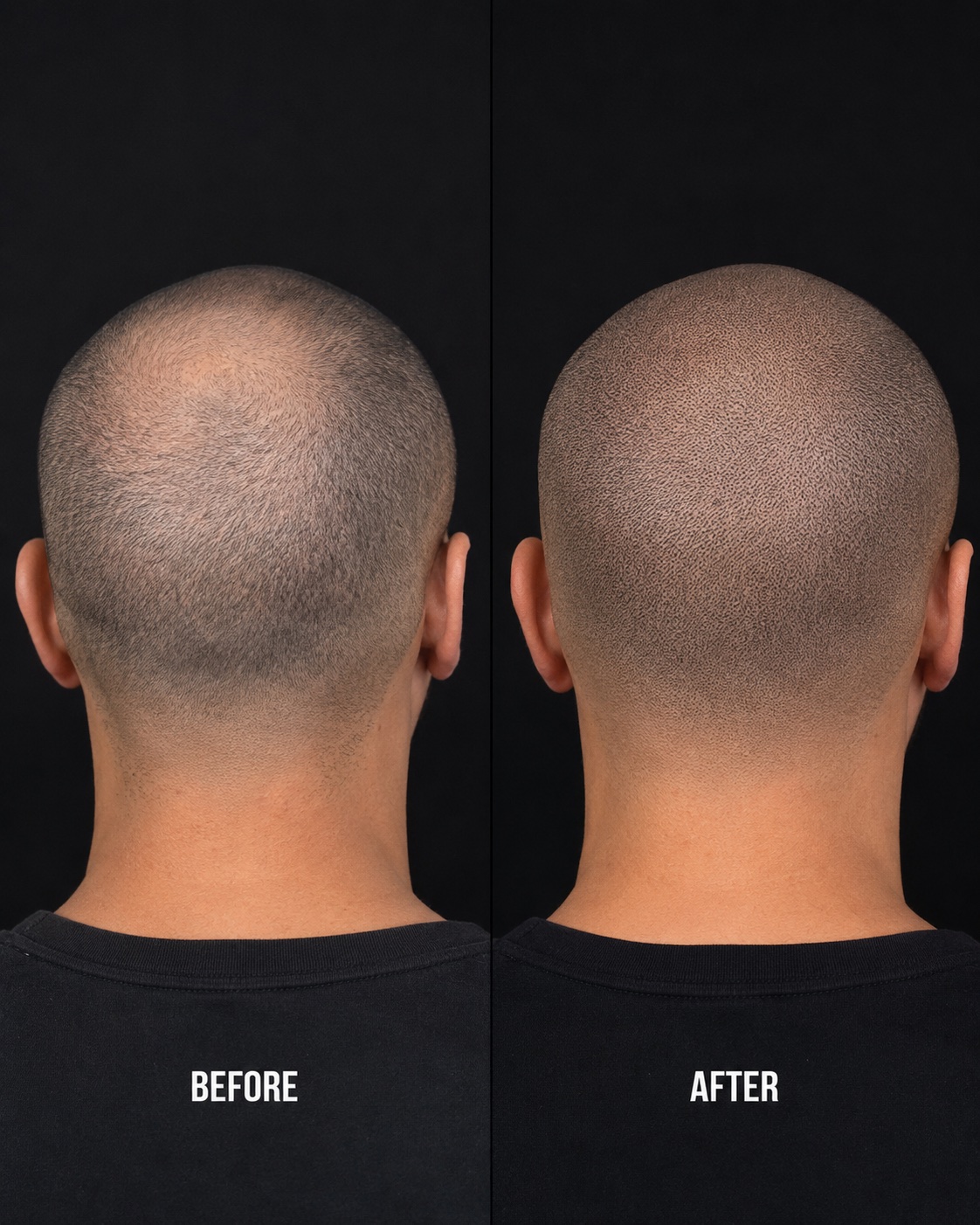 Simulated back view before and after scalp micropigmentation result